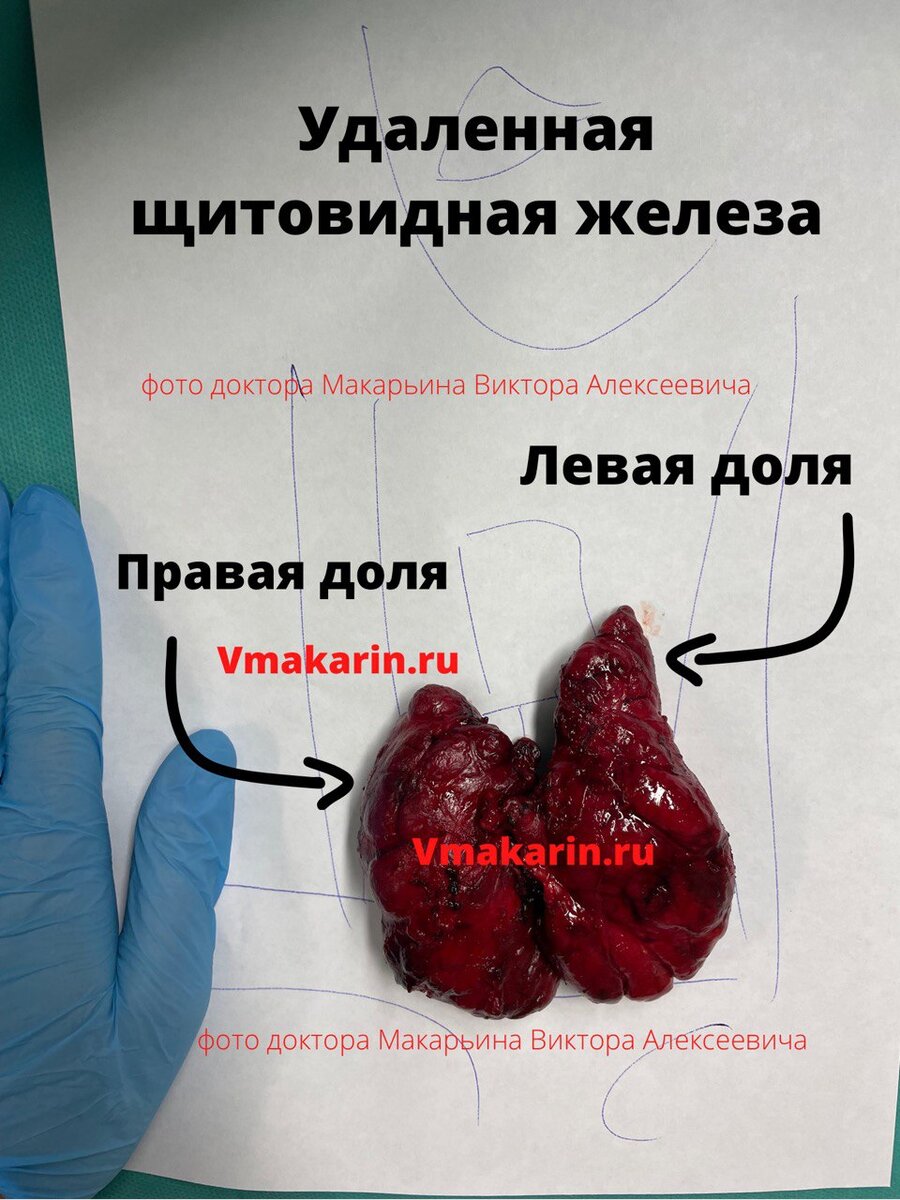 Щитовидная железа - где находится и ее строение? | Хирург-эндокринолог |  Виктор Макарьин | Дзен