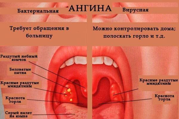 Почему возникает боль в горле