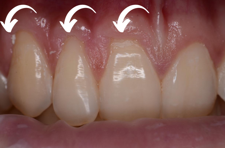 На фото стрелками показано убывания десны-  шейка зуба частично обнажена