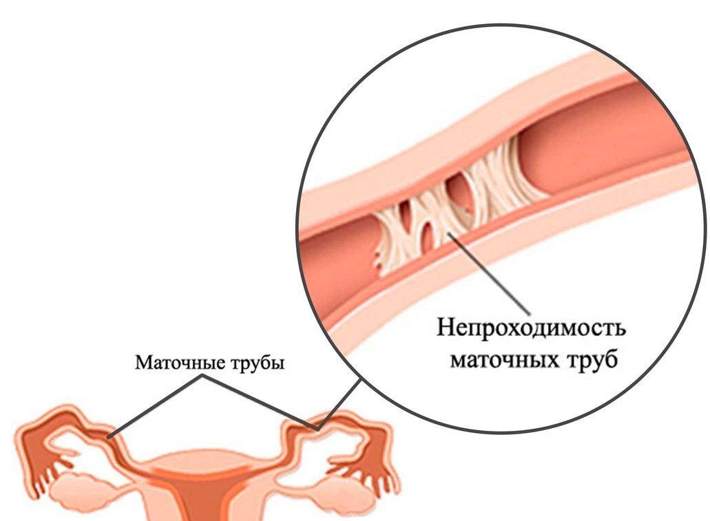 Трубно перитонеальное бесплодие презентация