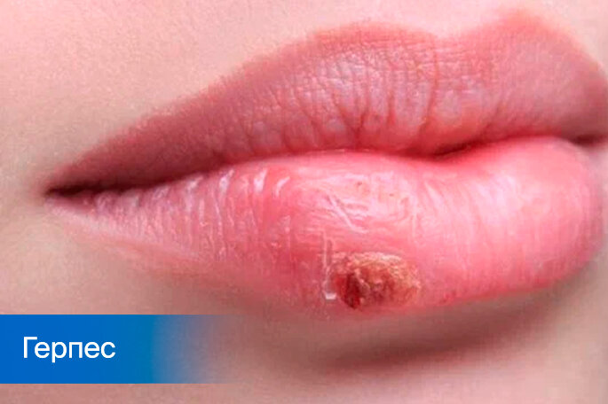 Герпес