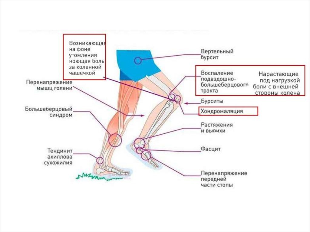 Почему болит бедро при ходьбе. Боль в области колена сбоку наружной стороны. Болит колено с наружной стороны. Болит под коленом сбоку с внешней стороны.