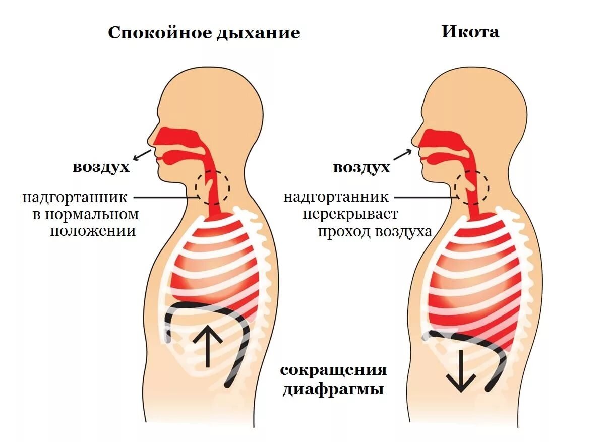 Судороги дыхания