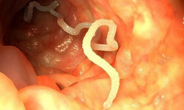 Знакомство с ними может привести к ряду очень неприятных последствий – от нарушения пищеварения до хирургического вмешательства. Давайте разберемся, когда стоит паниковать и бежать к врачу, ведь, как правило, нежелательные гости никак себя не проявляют и сидят в организме тихо. Это может показаться странным, но признаки заражения следующие.🦠 Аллергия🦠 Сыпь на коже, зуд🦠 Заложенный, как при насморке, нос🦠 Частые простуды на фоне сниженного иммунитета🦠 Слабость, общее недомогание🦠 Боли в животе и запоры