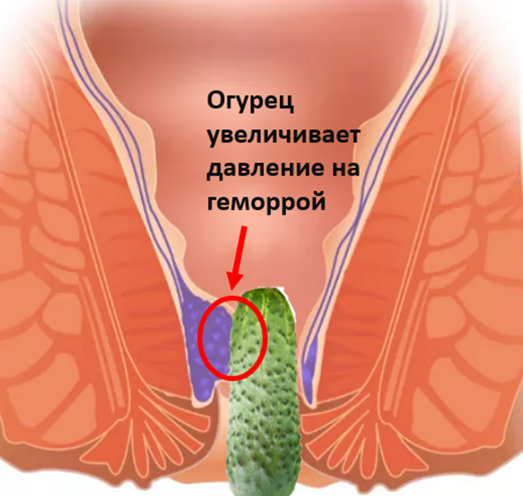 Лечение геморроя огурцом на гряд - Лечение геморроя огурцом на грядке