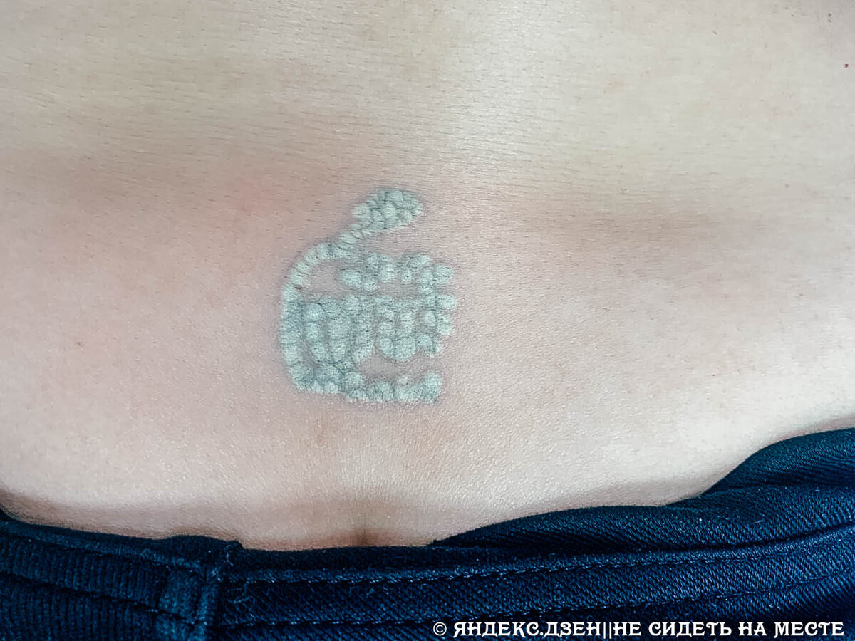 остаются ли следы после удаления лазером татуировок