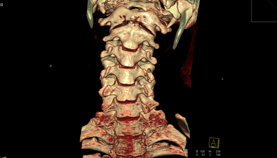 Кт шеи что показывает. Грыжа шейного отдела позвоночника кт. Мрт шейного отдела позвоночника остеохондроз. Остеохондроз грудного отдела кт. Шейный остеохондроз снимки мрт.