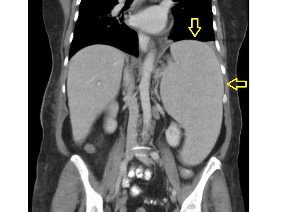 Стрелками отмечена гигантская селезенка