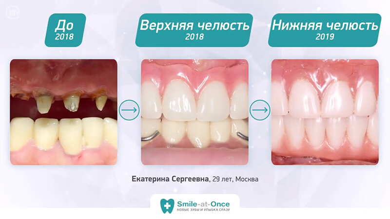 В течение 1,5 лет пациентка вернула все зубы: сначала за 3 дня восстановлена верхняя челюсть, через год – нижняя, так же за 3 дня.