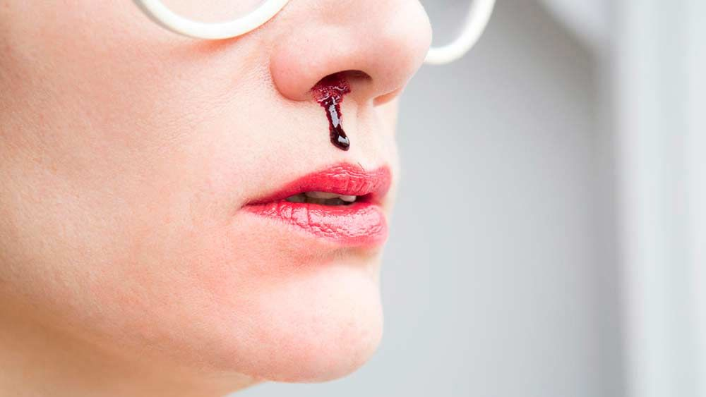Носовое кровотечение — что может вызвать данный симптом – лечение в ЦЭЛТ