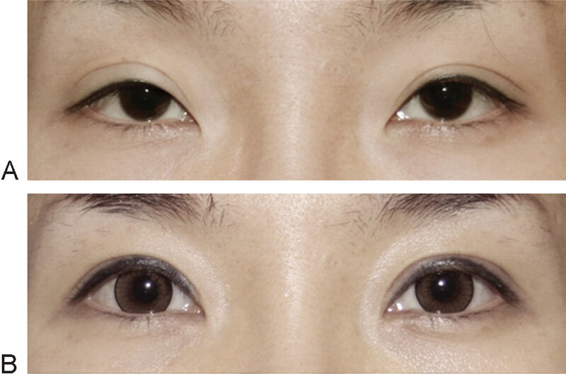 Some People Shouldn’t Get Lasik Eye Surgery—Here’s How to Know If You’re One of 
