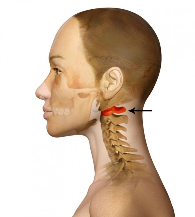 Подвывих шейного позвонка