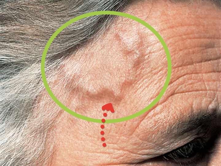 височный артериит.