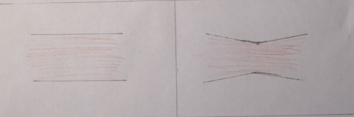 Норма/Спазм