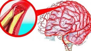 Со временем над жировым отложением образуется волокнистая шапочка. Даже под колпачком отложение может расти, постепенно блокируя кровоток и в конечном итоге вызывая боль в груди (стенокардию).