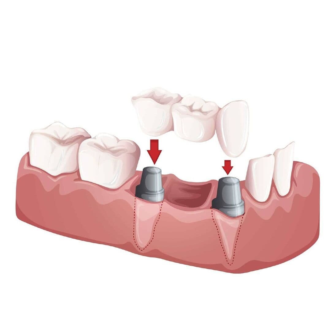 зубной мост на имплантах