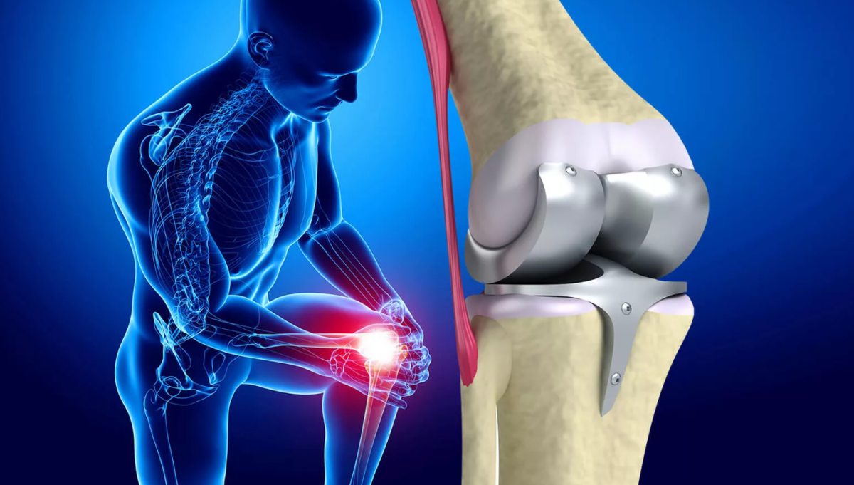 Эндопротезирование коленного сустава
