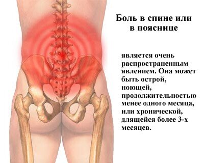 Локализация и виды болей в пояснице
