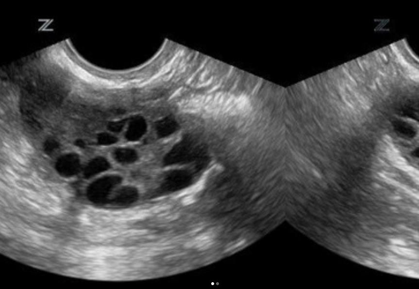 Эхо картина мультифолликулярных яичников