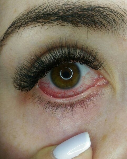Пример покраснения, если во время наращивания щипало глаза