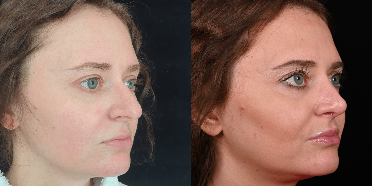 Фото с сайта хирурга Д.Р.Гришкяна, имеются противопоказания, требуется консультация специалиста. 