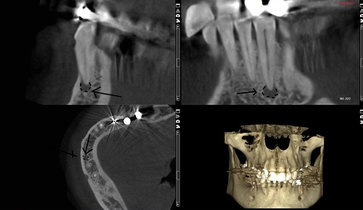 киста у корня зуба с разных ракурсов на КТ зубов
