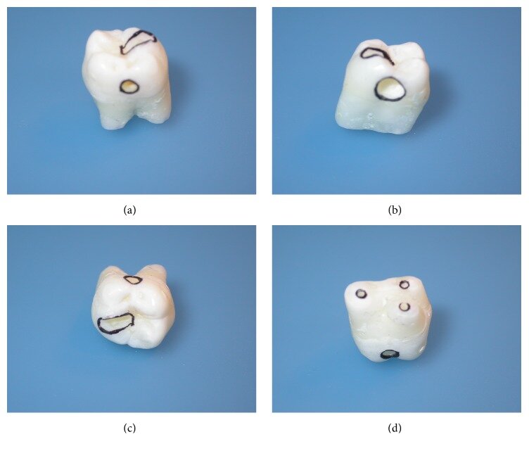 Препарирование зуба: (а) мезиальный вид с коробкой термопары в среднем положении; (б) дистальный вид с коробкой для обтурации; (в) окклюзионный вид с коробкой термопары в окклюзионном положении; и (г) вид корня, показывающий отверстие для термопары в пульповой камере.