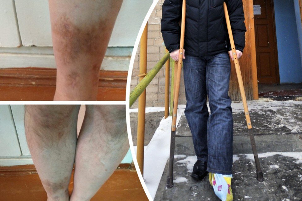     Новосибирские врачи спасли ногу рабочего, но штифт остался на всю жизнь. Фото: Предоставлено героем публикации// Олег РУКАВИЦЫН