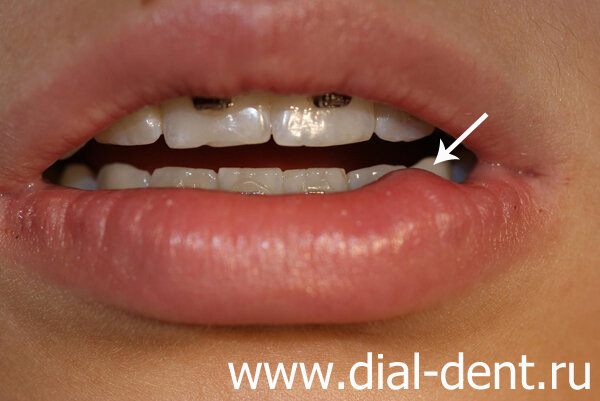 этот шарик на губе - ретенционная киста слюнной железы