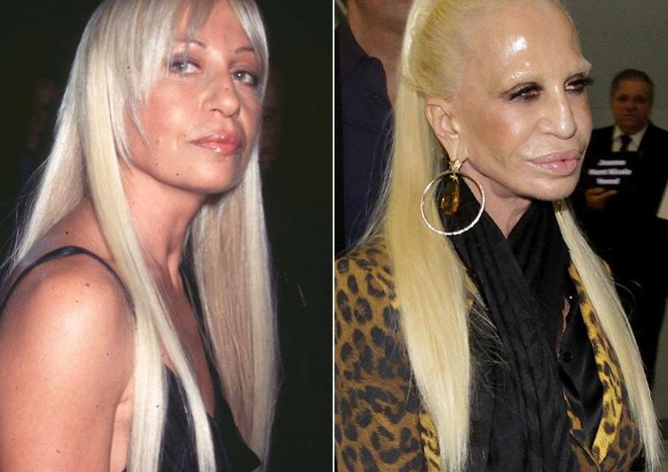 Major messup.. Bad celebrity plastic surgery, Celebrity plastic surgery, Plastic