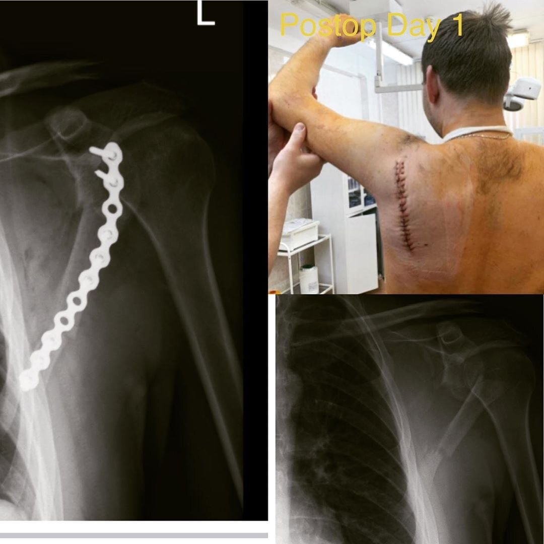 Картинки перелом лопатки