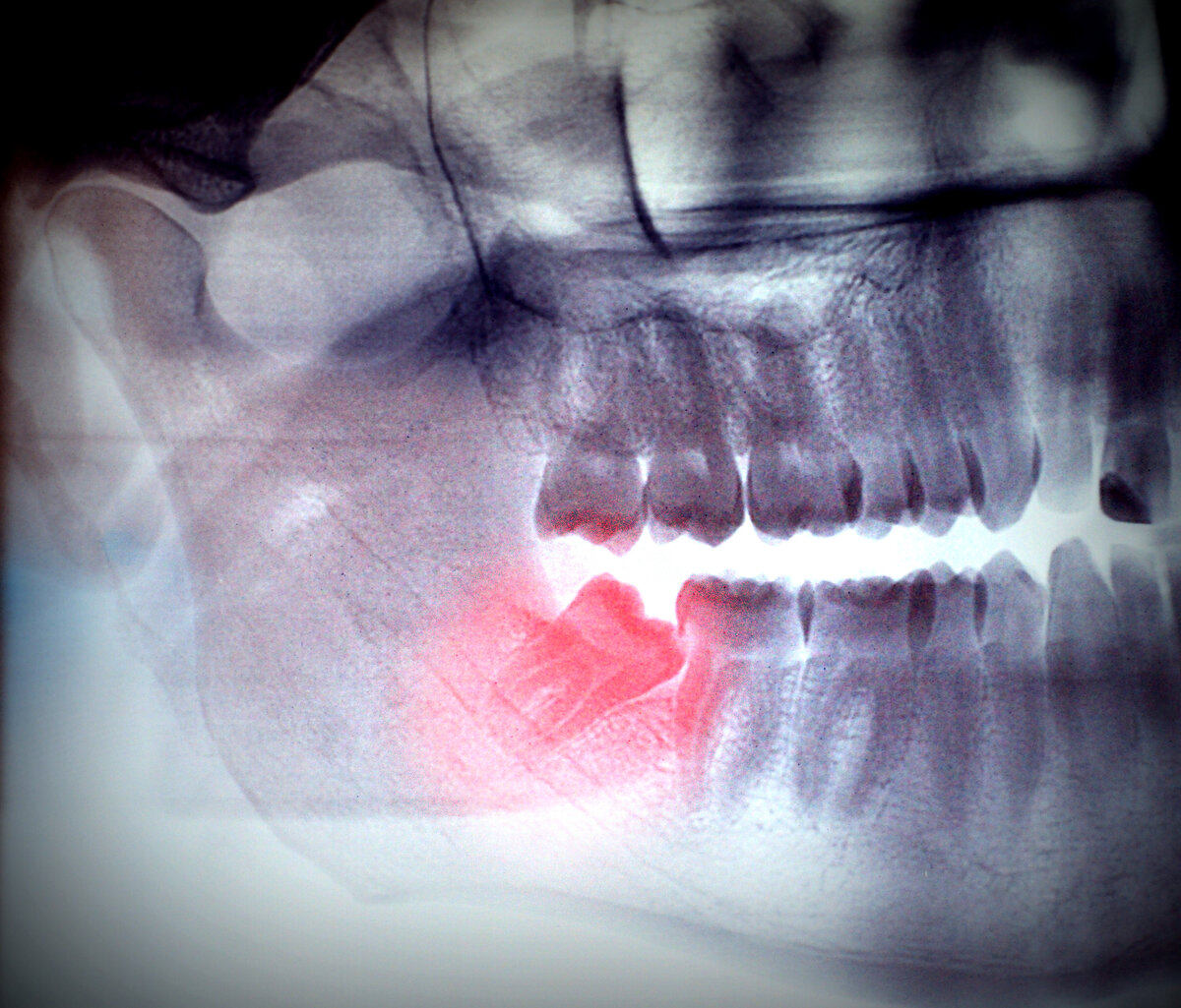 Ретинированный зуб мудрости. Фото: Яндекс.Картинки