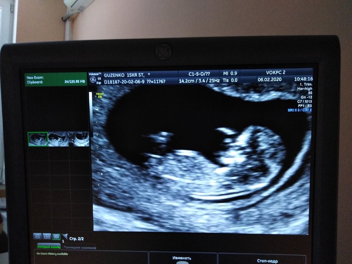 Первый скрининг