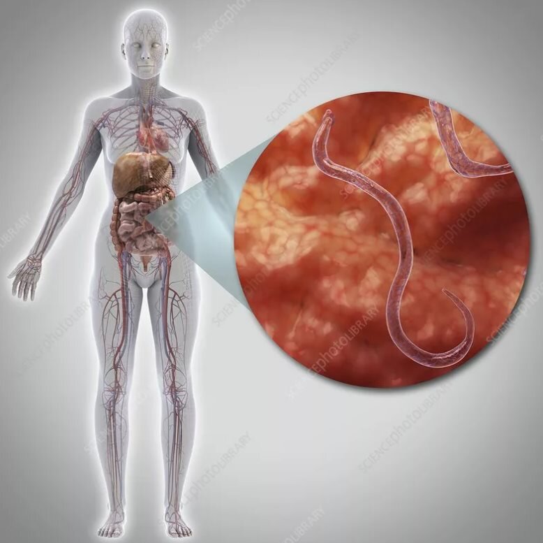 Болезнь более всего распространена в жарком и влажном климате. Развивается после того как в организм попали круглые черви Necator americanus. Они беспрепятственно проникают через кожу стоп. Защитить от них может только обувь! Данные ВОЗ свидетельствуют о том, что четверть населения земного шара заражена анкилостомидозом.