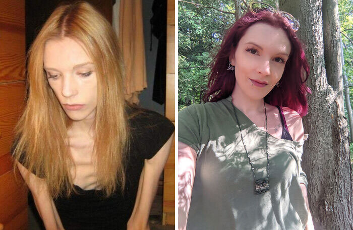 Источник: https://www.reddit.com/r/MadeMeSmile/comments/rafs37/today_i_am_6_months_fully_anorexia_and_bulimia