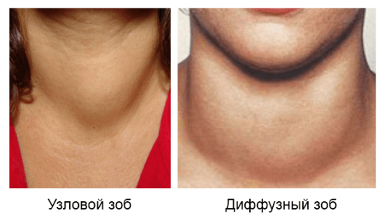 Как выглядит зоб фото