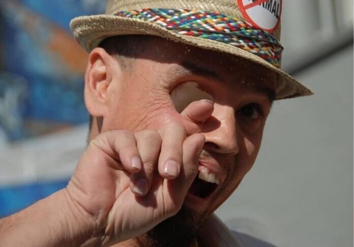 В 2013 году Билли потерял половину лица и одно из глазных яблок. Эта трагедия была результатом действия одной из редких форм рака. Чтобы спасти жизнь пациента, хирурги удалили часть его носоглотки и верхнего нёба. 
Оуэн принял свою новую жизнь, присоединившись к «Freakshow». И теперь зарабатывает себе на жизнь, участвуя в фестивалях и шоу про зомби.