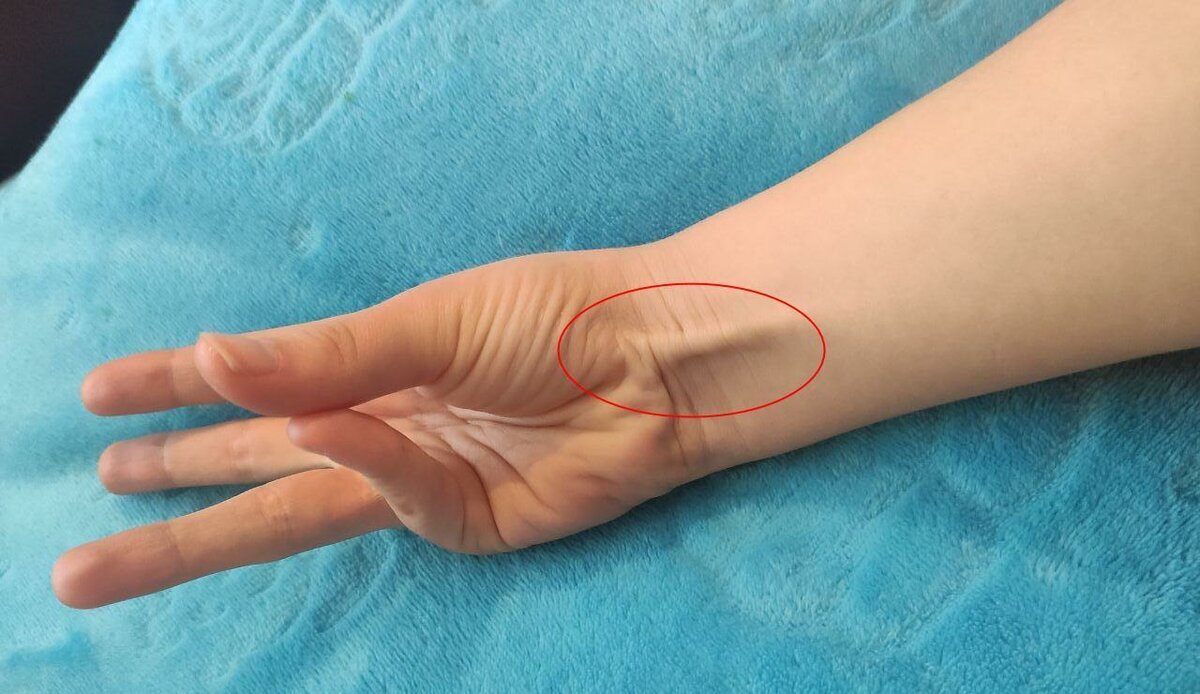У меня и знакомых длинная ладонная мышцы есть. А у Вас? :)
