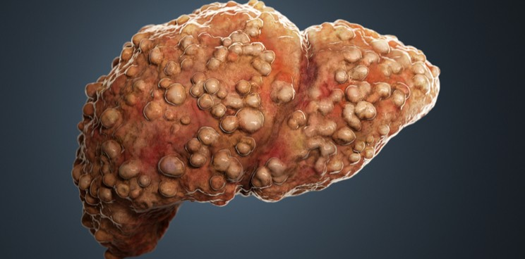 Итог развития фиброза  - цирроз печени и гепатоцеллюлярная карцинома