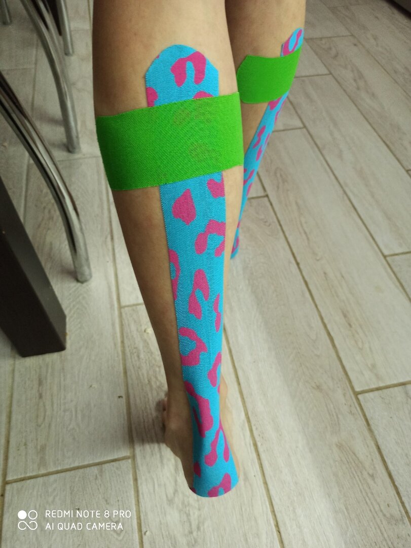 Тейпирование икроножной мышцы.