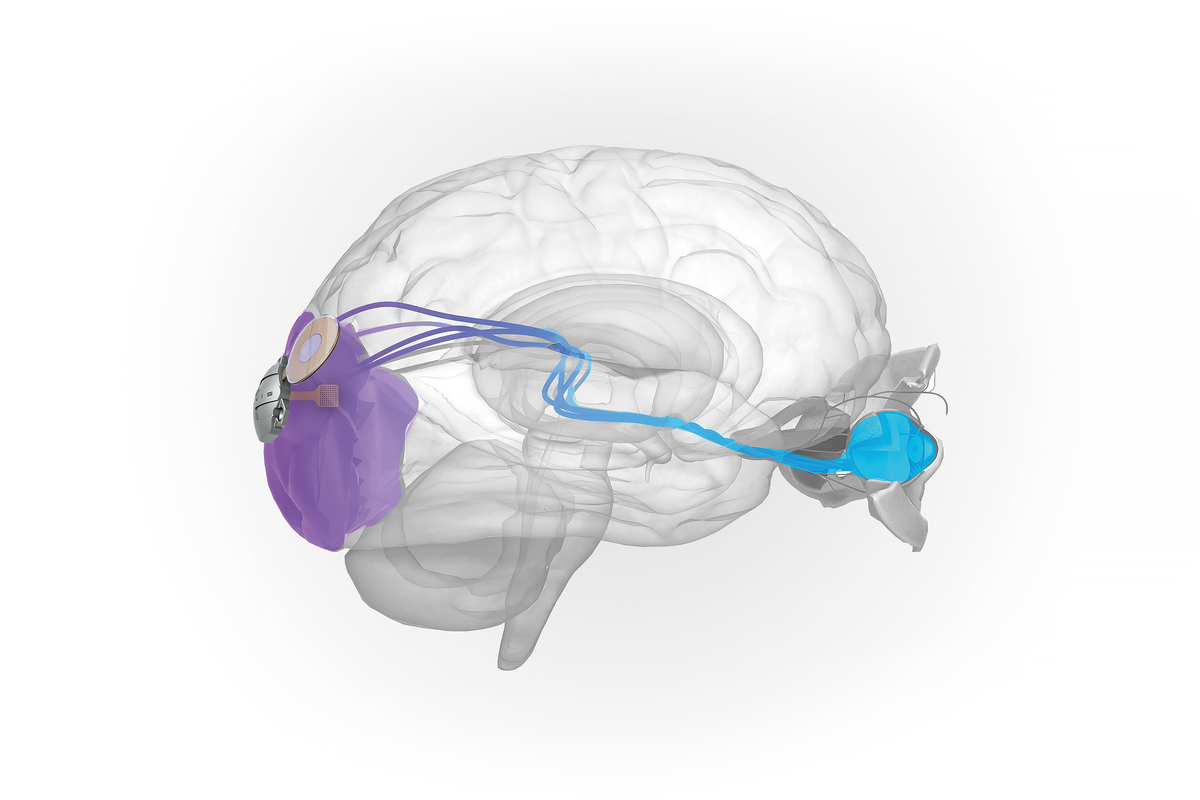 C brain. Нейроимплант Elvis. Имплант для головного мозга Elvis. Нейроимплант для восстановления зрения.
