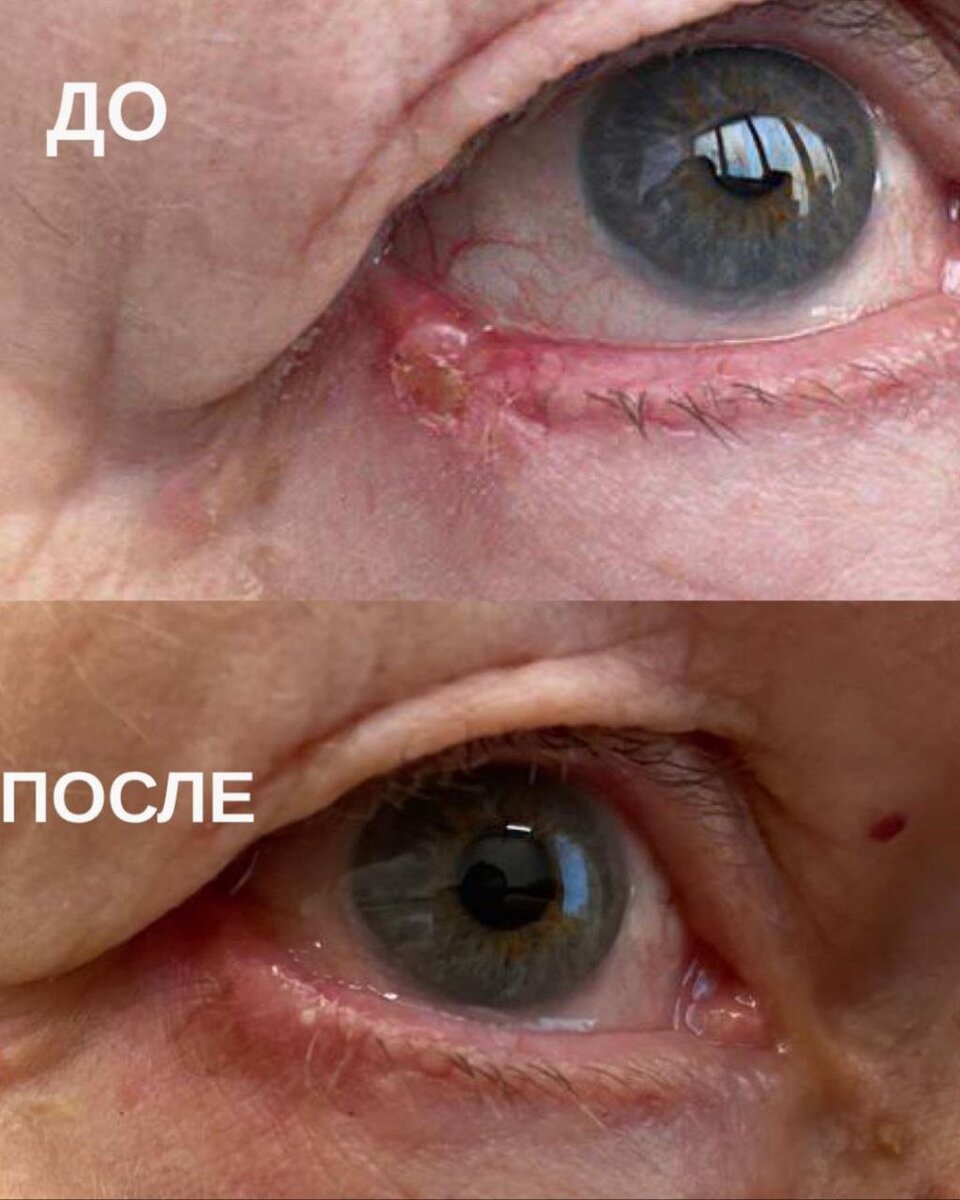 До и после фдт