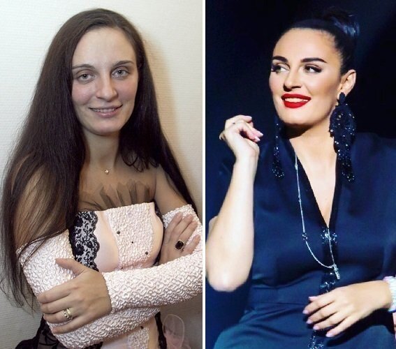 Ваенга пластика до и после
