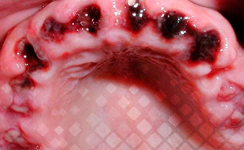 Кровотечение из лунки зуба: причины и способы остановить кровь