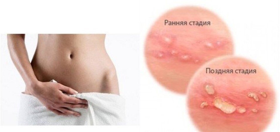 Герпес на половых органах