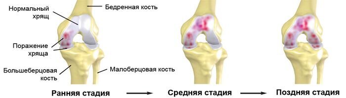 3 стадии артроза