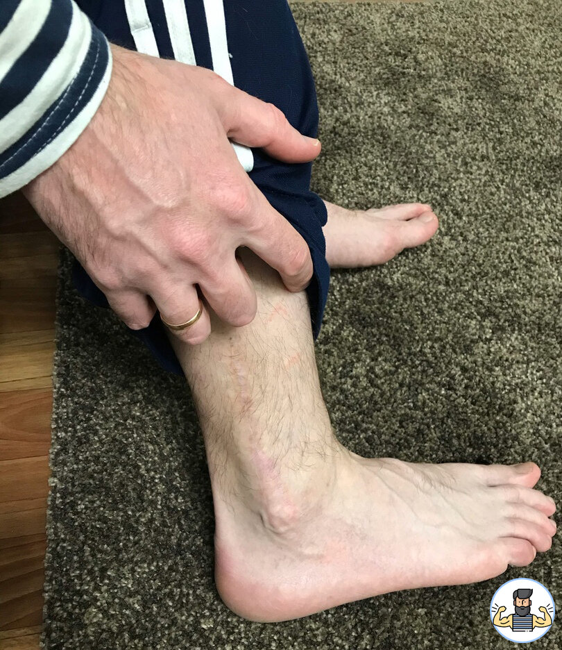 Мой шрам от операции на голеностопе