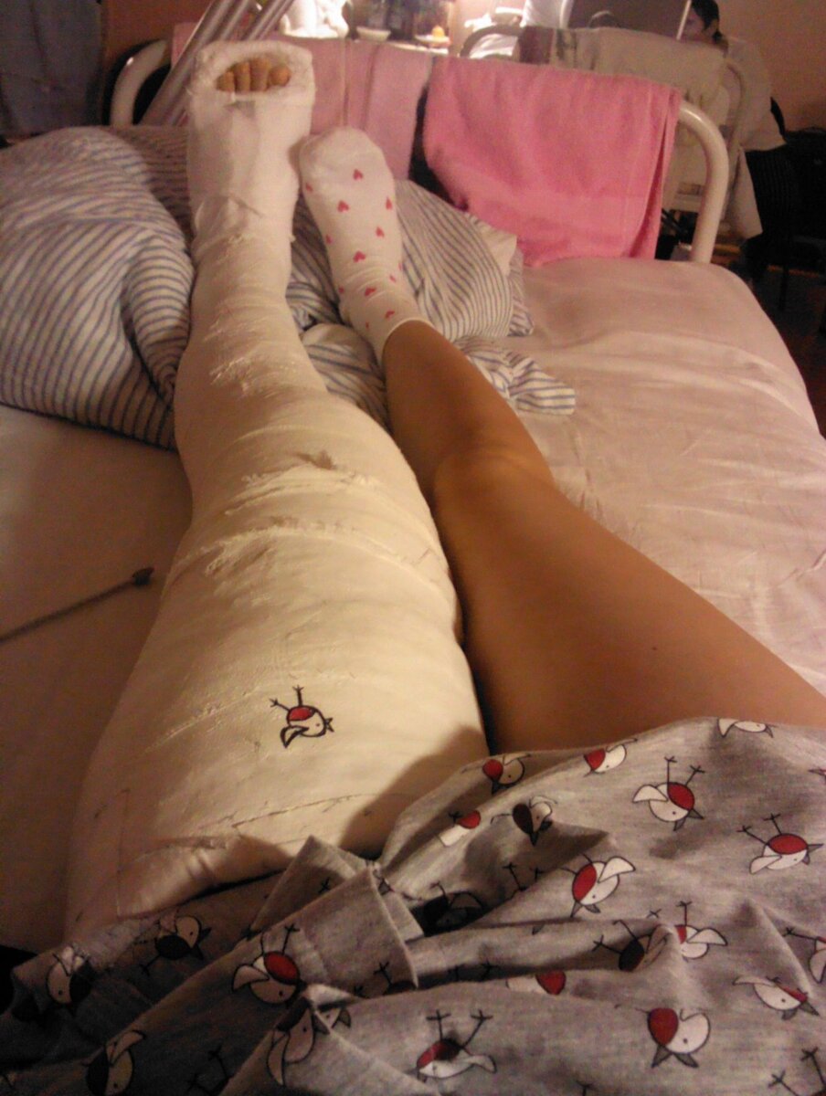 Целых два месяца женщина лежала с ногой, перелом оказался сложный.