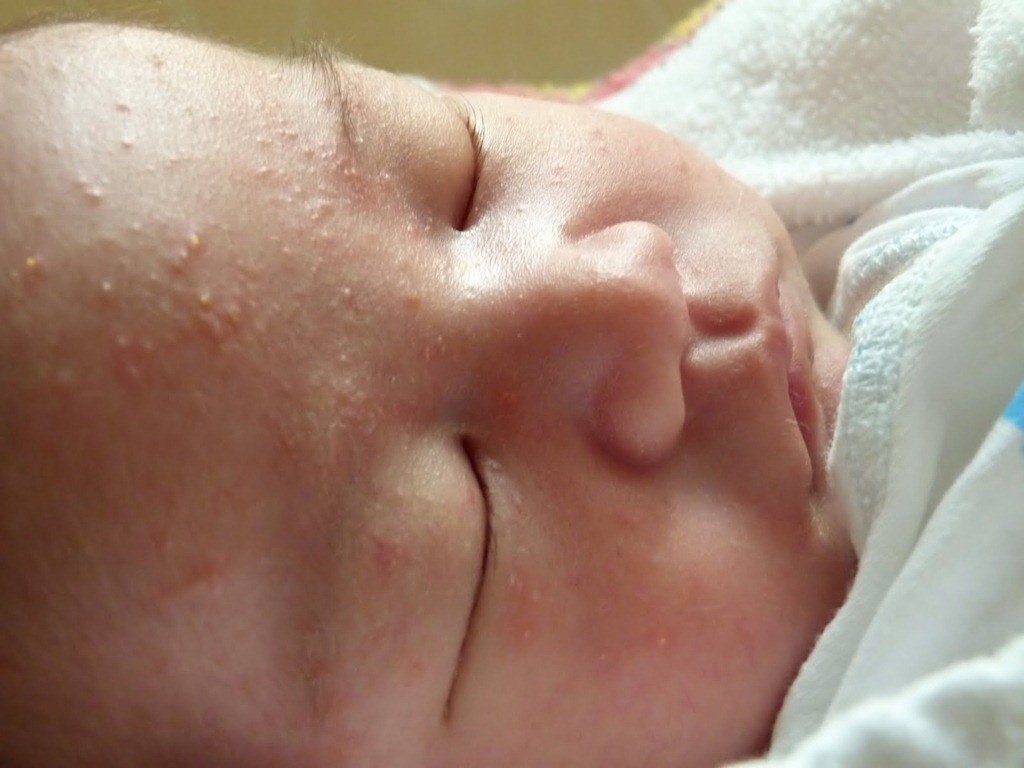 Цветение новорожденных: что собой представляет и как отличить от аллергии