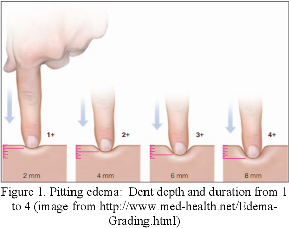 Как определяется пастозность конечности
